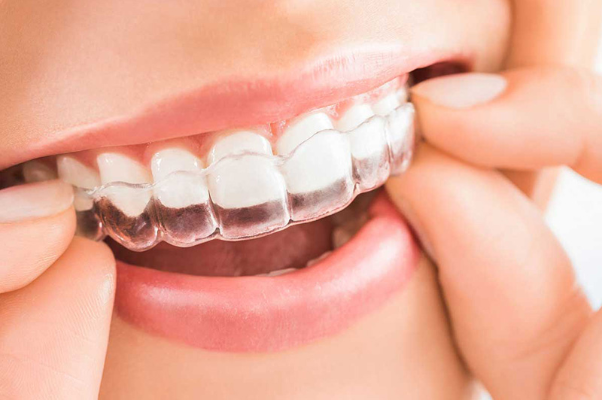 invisalign-alinhador-transparente-aparelho-florianopolis (1)